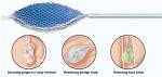 Stainless Steel Disposable Grasping Forceps Class II
