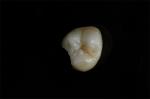 Customizable Ceramic Inlays And Onlays In Dentistry Restoration