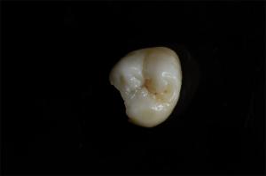 Quality Customizable Ceramic Inlays And Onlays In Dentistry Restoration wholesale