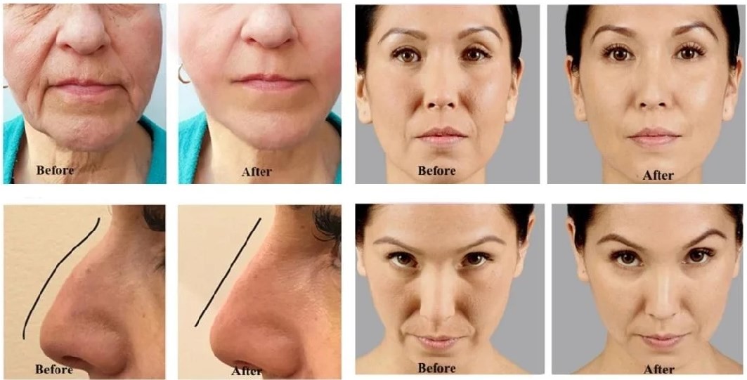 Fosyderm Hyaluronic Acid Face Dermal Filler Cross Linked HA Gel 1ml 2ml 5ml