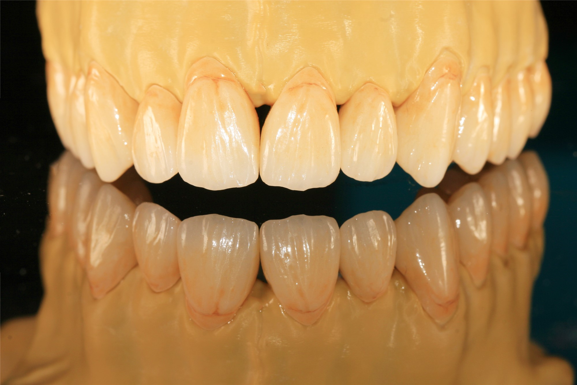 Great Biocompatibility Full Contour Zirconia Dental Crown For Dental Laboratory