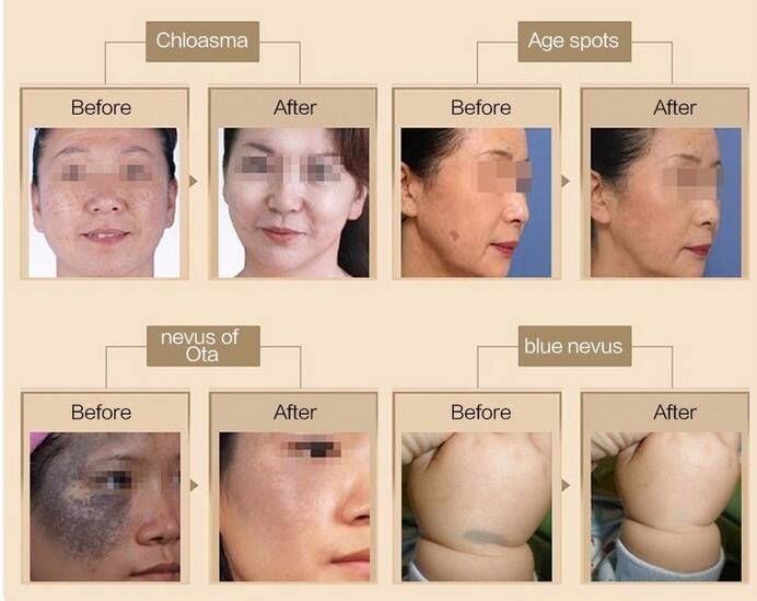 mini picosecond laser for pigment removal, speckle removal