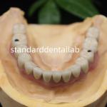 Screw Retained Dental Implant Metal Ceramic Crowns Malo Bridge