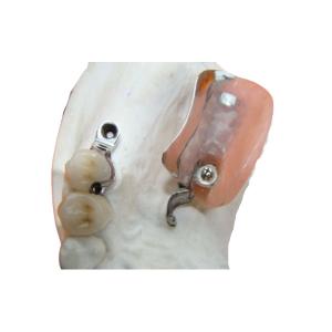 Quality Dental Lab Long Lasting Precision Attachment Denture Stain Resistant wholesale