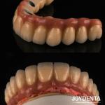 Casting And Milling PFM Tooth Crown , Dental Restorations Porcelain Fused Metal