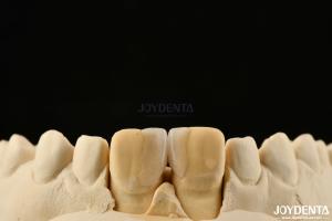 Quality 0.2mm Thickness Microthin Veneers Glass Ceramic Dental Veneers For Front Teeth wholesale