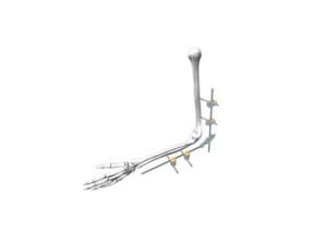 Quality Safety External Fixation System Dissection IV Φ5- Children’S Elbow Fixation wholesale
