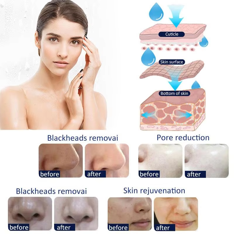 14 In 1 Ultrasonic Scrubber RF Bio Facial Cleaning Hydrodermabrasion Machine