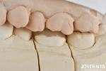 Adhesive Cementation Zirconia Dental Inlays And Onlays Natural Looking