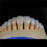Dental Lab Teeth Feldspathic Porcelain Veneers Custom Shaped