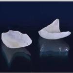 Natural Looking All Porcelain Veneers EMAX Dental Crown