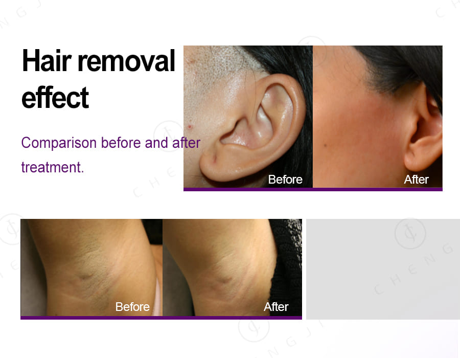 Professional Hair Removal Laser Machine 2000W Diode Laser Equipment Intelligent