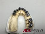 China Dental Lab Dental Implant Attachments Adjustable Telescopic