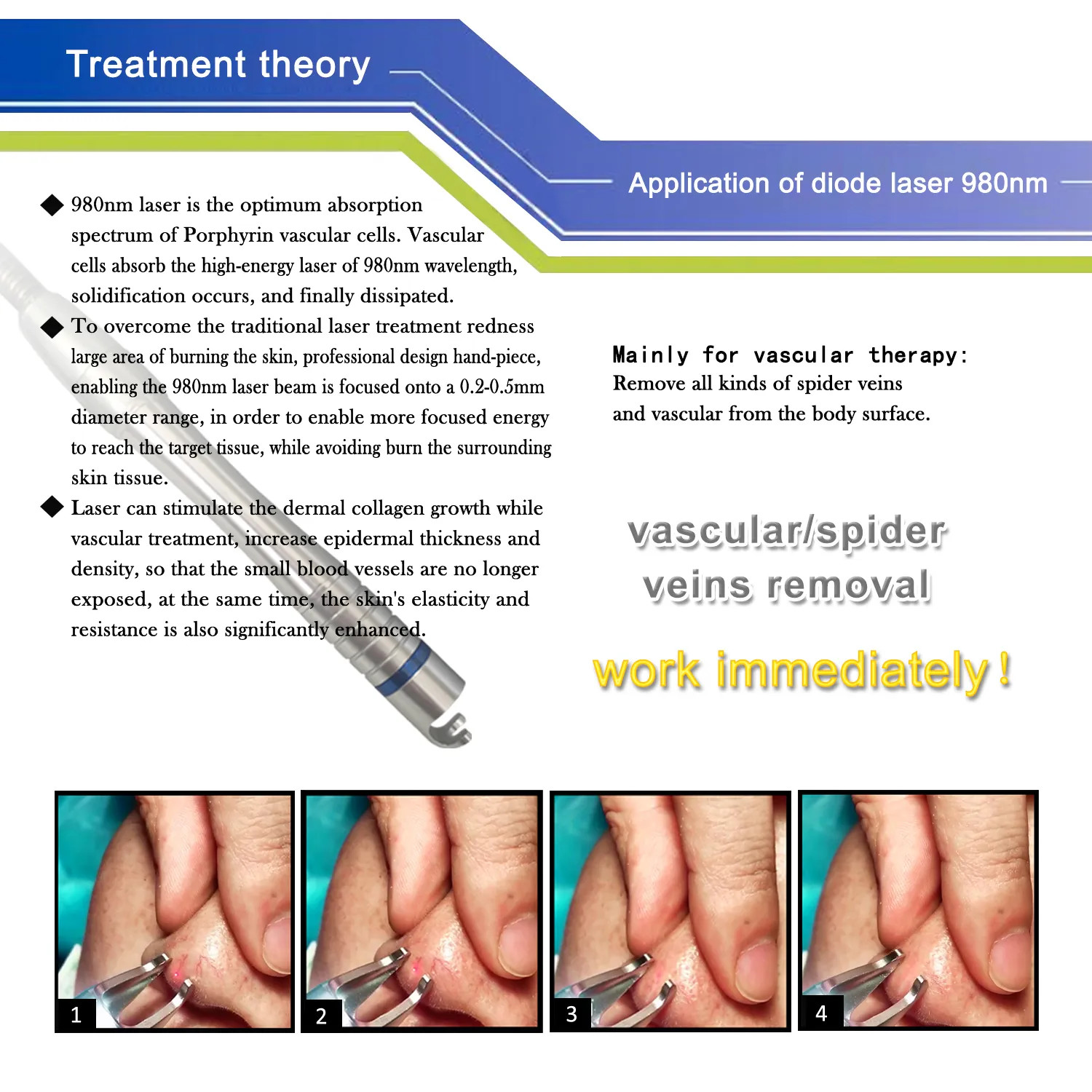 Professional 30W Laser Beauty Machine 980nm Diode Laser Spider Vascular Vein Removal