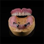 CAM Milled Titanium Bar Dental Implant Hybrid Prosthesis Dentures