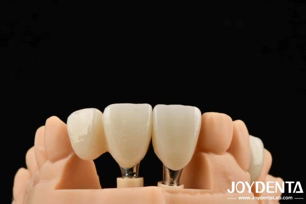 Close Friends Of Bones Foundation Of Beauty Zirconia Implants Aesthetic