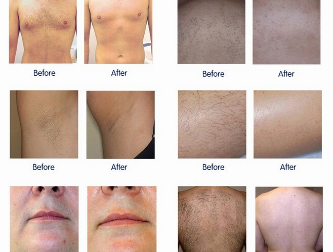 CE Approved Diode Laser Hair Removal Machine For Skin Rejuvenation 1 Year Warranty