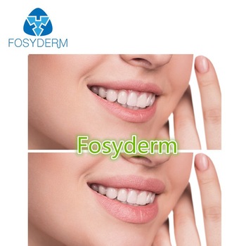Fosyderm Hyaluronic Acid Forehead Wrinkles 1ml 2ml Injectable Filler Type