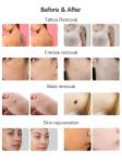 NIR Milk Light Whitening Beauty Equipment 3 Wavelength 755 808 1064 Permanent