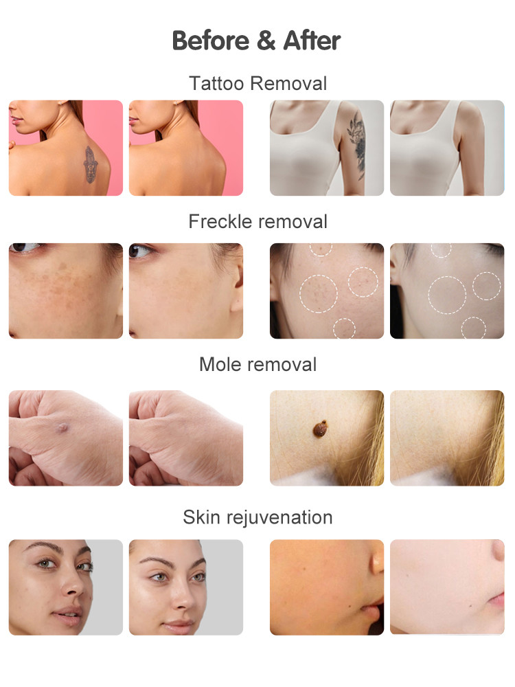 NIR Milk Light Whitening Beauty Equipment 3 Wavelength 755 808 1064 Permanent Painless 808 Diode Laser Machine Hair Removal Laser