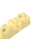 DLP Alike Temporary Crown Bridge Resin Precision Dental 3d Printing Resin
