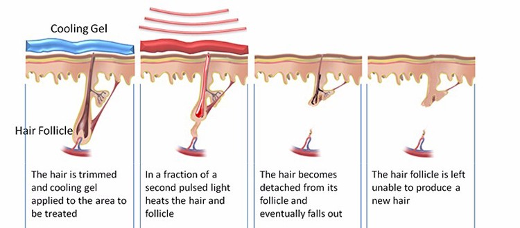 Painless Fast Diode Laser Hair Removal Machine Skin Rejuvenation Equipment
