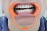 Disposable Cheek Retractors Dental Medical Dental Cheek Retractor Soft Dental