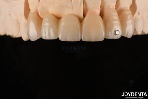 Quality CAD / CAM Milling Dental Layered Zirconia For Single Crowns 0.3-0.5mm Layer Thickness wholesale