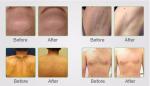800-810nm beauty 808 diode hair removal machine with our own factory