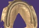Zirconia Dental Crown: Natural-looking Teeth, Durable & Secure