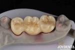 Customizable Dental Implant Supported Bridge And Crown For Dental Implants