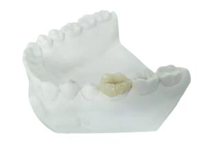 Quality Durable FDA All-Ceramic Dental Crown Veneer Inlay Onlay Similar wholesale