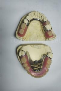 Quality PEEK Upper Removable Partial Denture Requires Regular Maintenance wholesale