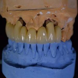 Quality Strong Transparency Ceramic Dental Crown Good Abrasion Resistance Long-lasting wholesale