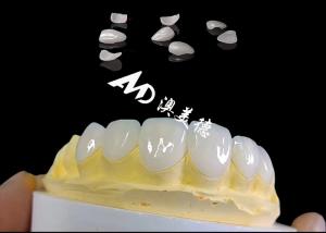 Translucencys IPS Emax Veneers , Minimal Preparation Emax Dental Veneers