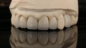 Quality China Dental Lab Zirconia Full Contour Crown High Aesthetic Natural Dental Bridge 5 Year Guarantee wholesale