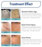 Radio Frequency Fractional And Micro Needling Rf Machine Gold Microneedling Skin
