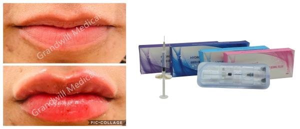 Cross Linked Sodium Hyaluronic Acid Injection Dermal Filler For Lip Fullness
