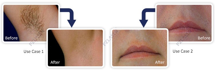 Medical Equipment 808nm Laser Depilation Machine Hair Removal 1 - 20Hz Frequency