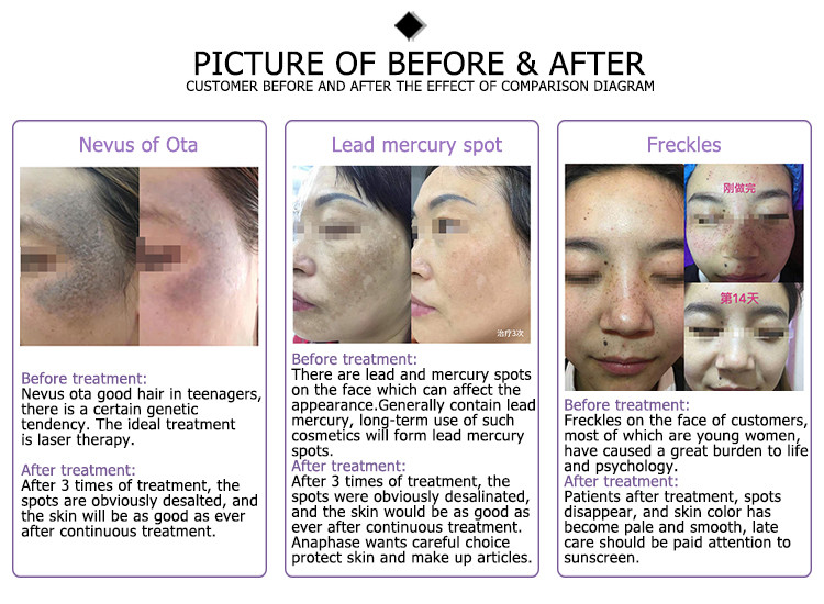 hottest pigmentation removal machine neat cell aesthetic shanghai tattoo remover Pico second Laser
