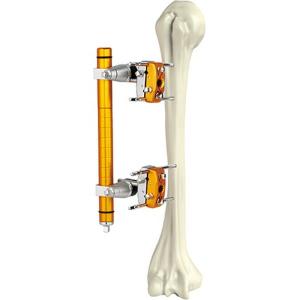 Quality Medical Orthopedic Surgical Instruments Humeral Shaft External Fixator wholesale