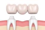 Oral Hygiene Safety Porcelain Tooth Crown High Wear Resistance High Finish