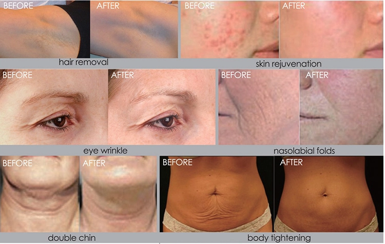 Clinic Multi Function Laser 3 Handpiece Nd Yag Laser Rf Skin Tightening Machine