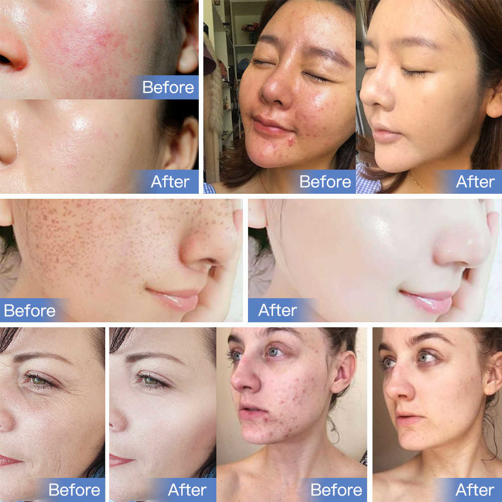 Led Light Therapy Equipment For Face Wrinkles Rosacea Treatment