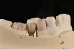Sandblasted Single Tooth Implant With Self Tapping Thread And Internal Hex