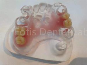 Quality Hypoallergenic Stain Resistant TCS Valplast Dental Prosthetics For Long Lasting Comfort wholesale