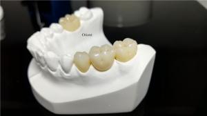 Quality Ceramic Dental Crown,Zirconia Dental Crowns wholesale