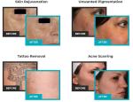 755nm picosecond laser/picosure laser/tattoo removal laser