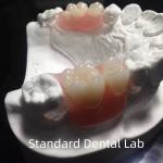 Flexible Clear Metal Cast Framework Partial Dentures High Esthetics Perfect Fit