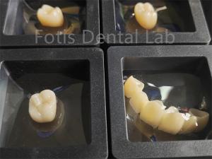 Quality Dental Restorations Zirconia Multilayer Fracture Resistance wholesale